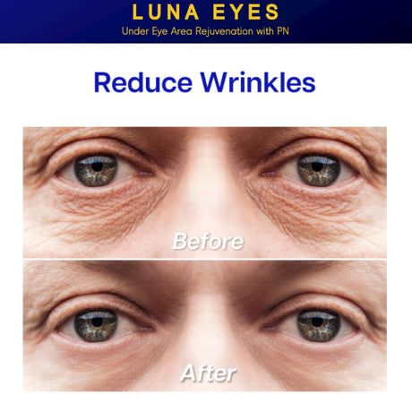 Luna Eyes Rejuvenation PN - Filler Lux™ - Mesotherapy - Let It beauty Co., Ltd.